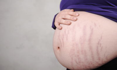 お腹の妊娠線画像例２↓